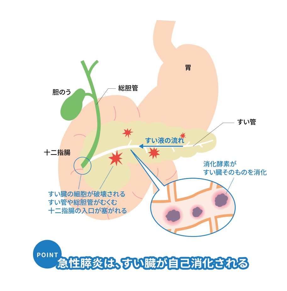 すい液の流れ 消化酵素がすい臓そのものを消化 すい臓の細胞が破壊される すい管や総胆管がむくむ十二指腸の入口が塞がれる POINT 急性すい炎は、すい臓が自己消化される 伊佐治秀司監修：図解決定版 すい臓の病気と最新治療&予防法,p57,日東書院,2016.