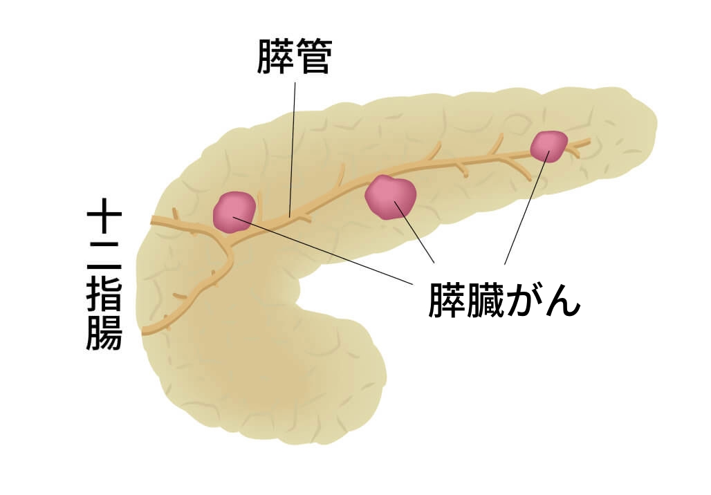 膵臓がんのイラスト