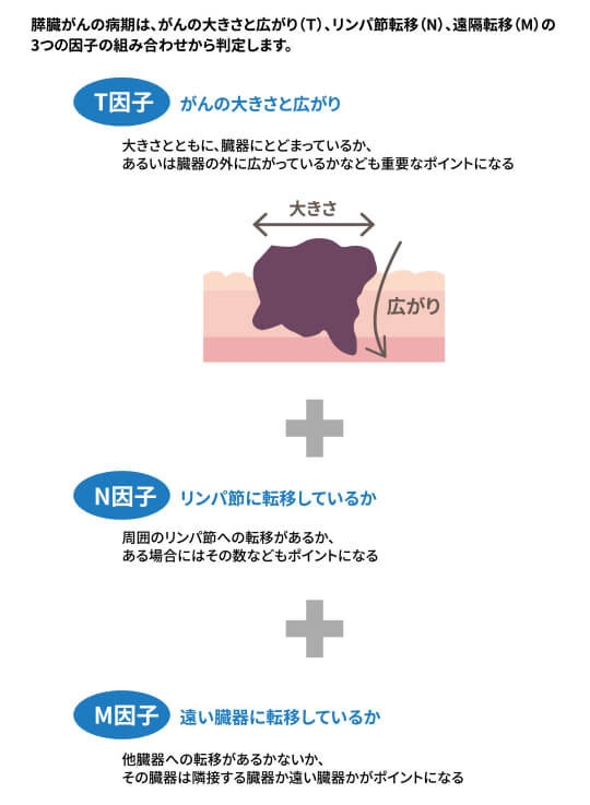 3つの因子（TNM）から病期を判定するのイラスト