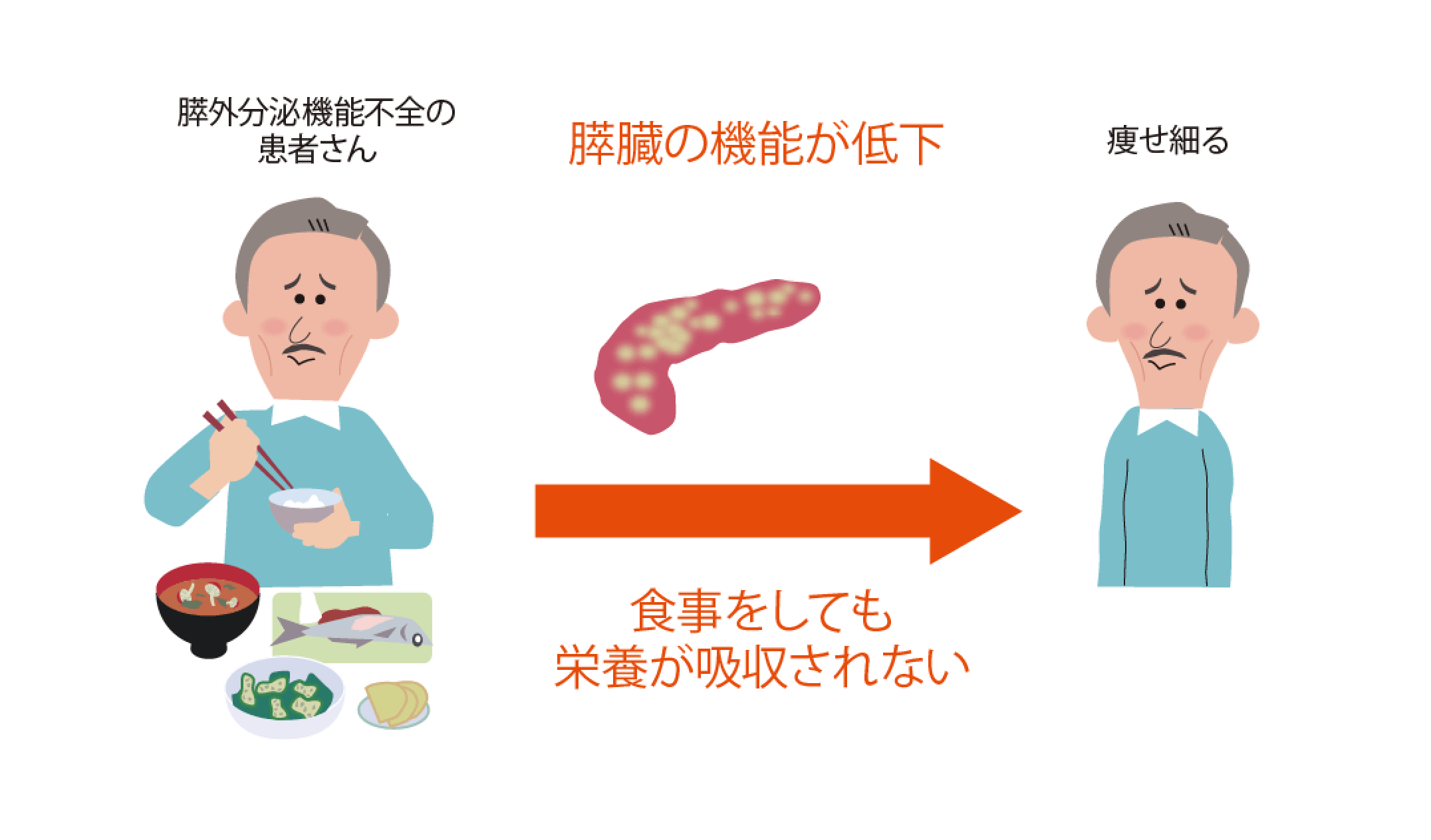 膵外分泌機能不全