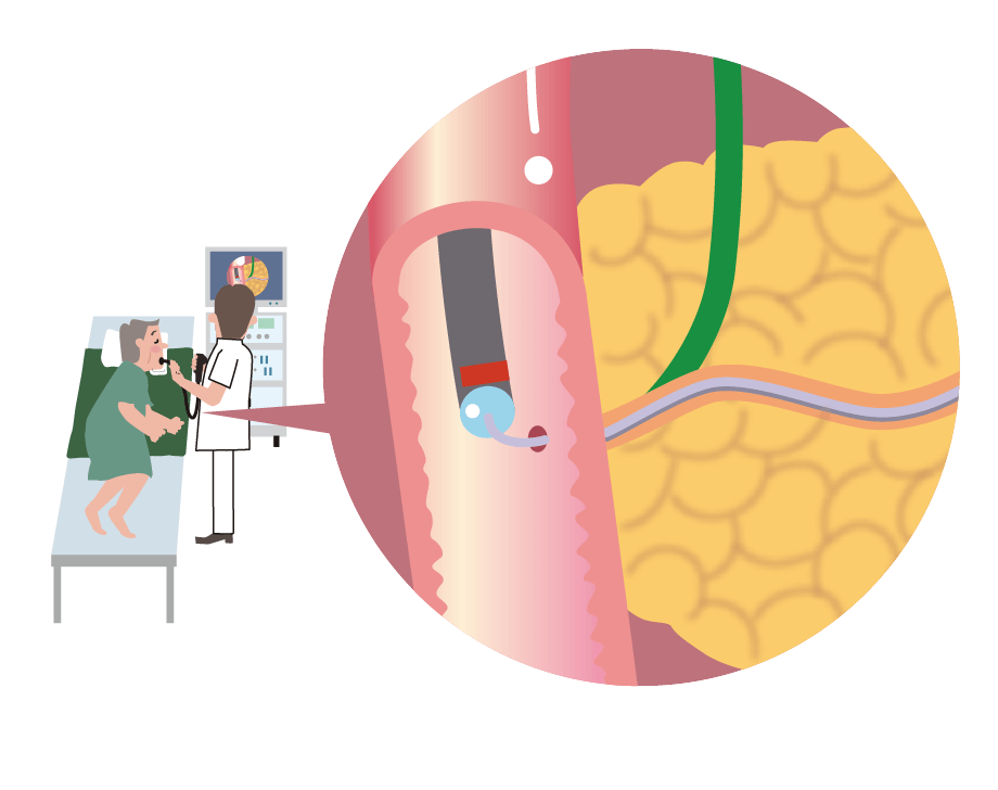 ERCP（内視鏡的逆行性胆管膵管造影）検査